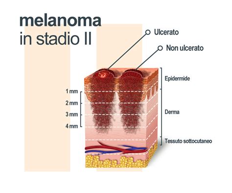 melanoma 4 stadio aspettative di vita